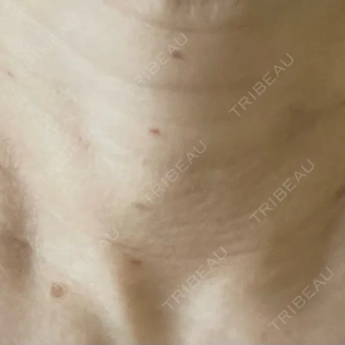 ジャルプロ ゆきスキンクリニック 東池袋 BEFORE メイン用