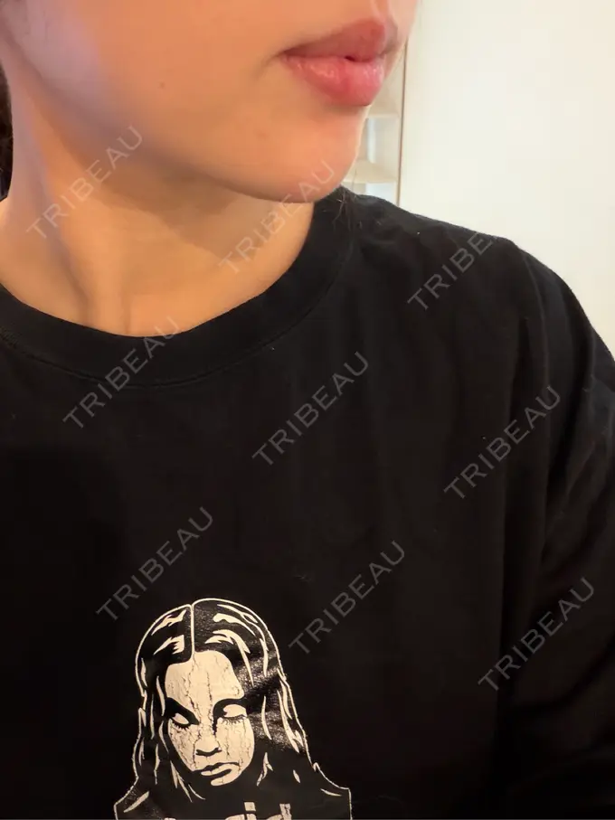 ボトックス（あご） / ヒアルロン酸注入（あご） TCB東京中央美容外科 越谷院 BEFORE メイン用