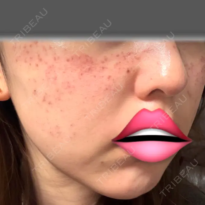 ピコスポット 東京シルククリニック 新宿院 BEFORE メイン用