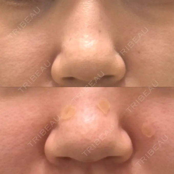 ボトックス（エラ・小顔） / ハイフ（顔） / ほくろ・いぼ除去レーザー（肌） 共立美容外科 福岡院 BEFORE メイン用