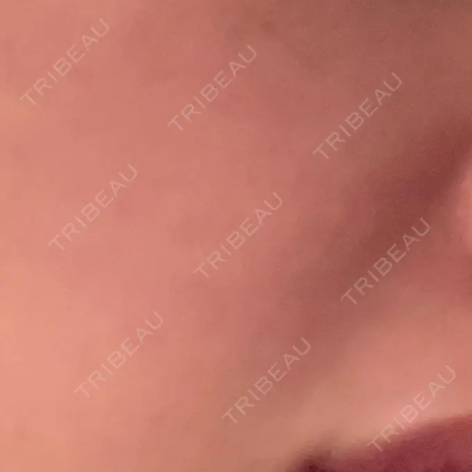 切開リフト GRACY TOKYO CLINIC【グレイシートウキョウクリニック】 BEFORE メイン用