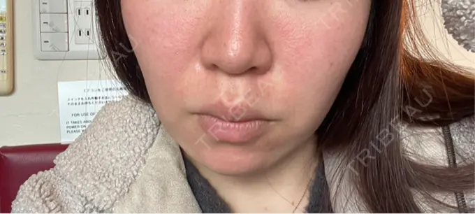 ハイフ（顔） 共立美容外科 福岡院 BEFORE メイン用