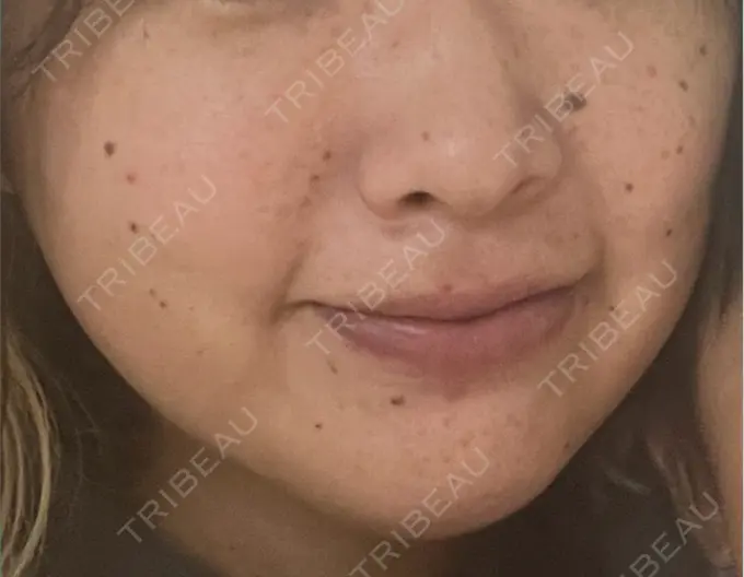 イオン導入 ルラ美容クリニック 千葉院 / ルラスキンクリニック 千葉院 BEFORE メイン用