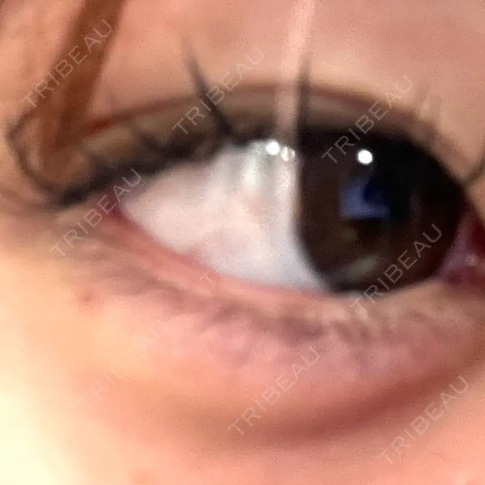 ヒアルロン酸注入（涙袋） フィラークリニック 大阪梅田院 BEFORE メイン用