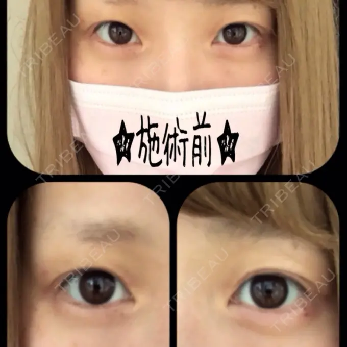 二重切開 / 目尻切開 / タレ目形成・グラマラスライン（切開） 高須クリニック 名古屋院 BEFORE メイン用