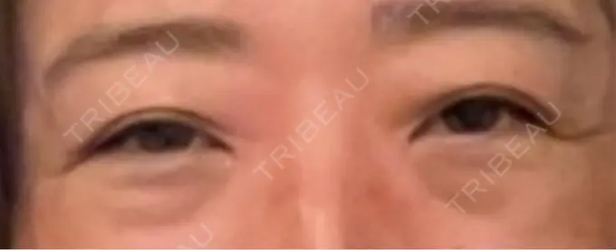 下まぶたたるみ取り / 下まぶたの脂肪取り / 眉下切開 / その他（目元） LOCHIC CLINIC GINZA【ロシッククリニック銀座】 BEFORE メイン用