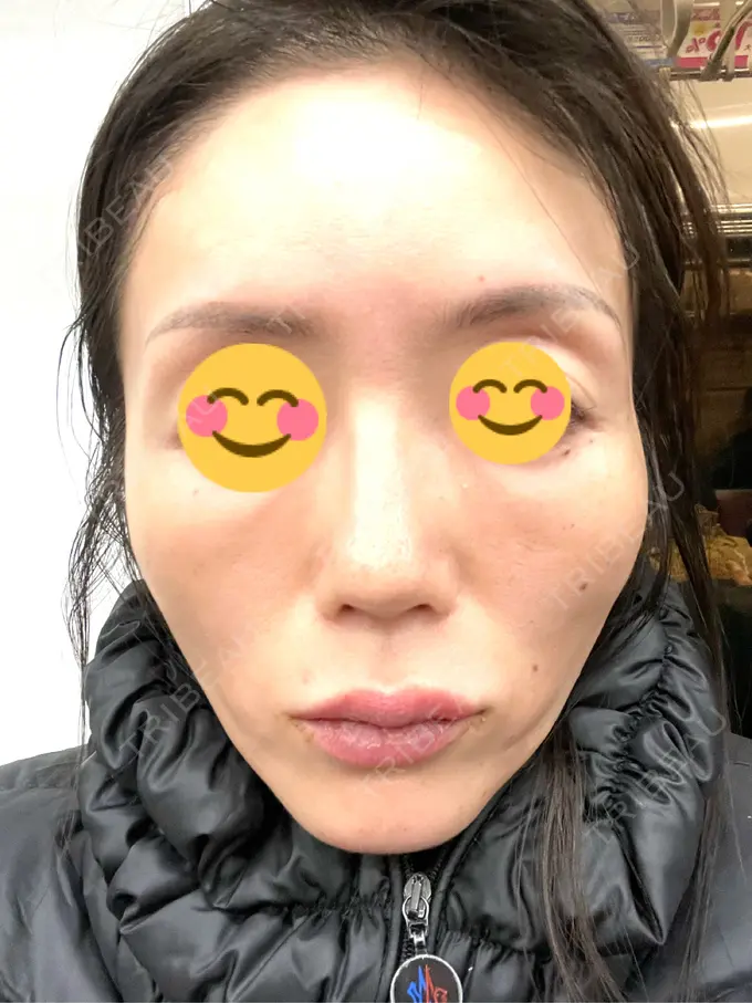 ボトックス（あご） / ボトックス（口角） / ボトックス（眉間） / ボトックス（目尻） 新宿三丁目メディカルクリニック BEFORE メイン用