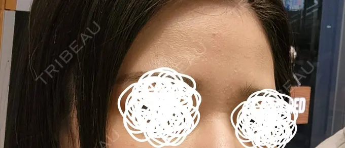 リジュラン 湘南美容クリニック Regno 銀座院 BEFORE メイン用