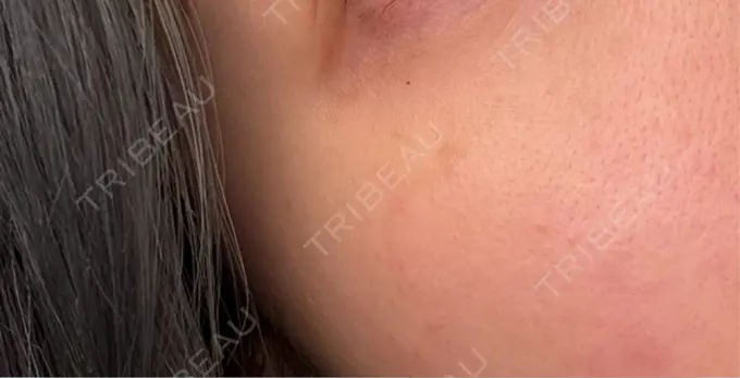 ルメッカ PureMe Skin Clinic（ピュアミースキンクリニック麻布） BEFORE メイン用