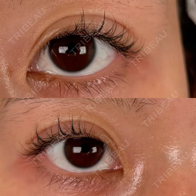 眼瞼下垂（非切開） SOL CLINIC BEFORE メイン用