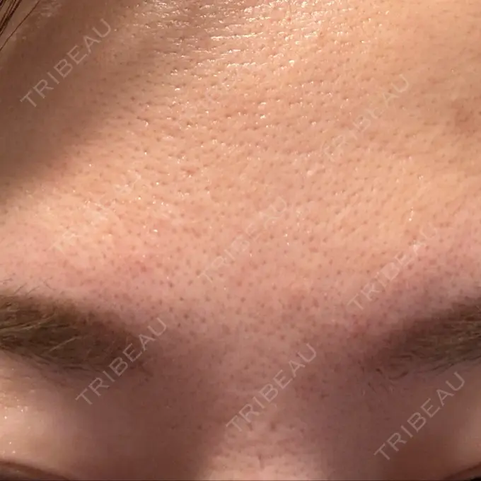 ボトックス（眉間） TCB東京中央美容外科 千葉駅前院 BEFORE メイン用