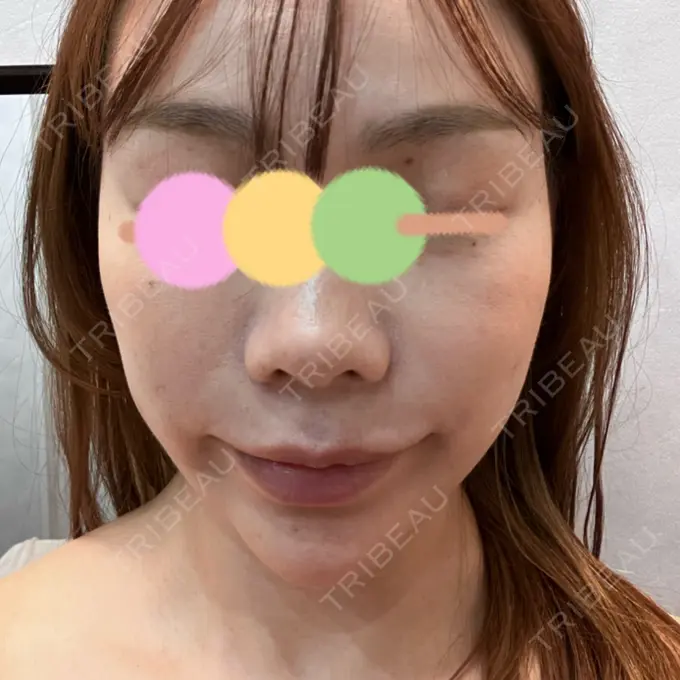 インディバ（顔） WOM SALON【術後ケア取扱いサロン】 BEFORE メイン用