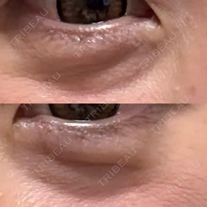 クマ治療 セオリークリニック BEFORE メイン用