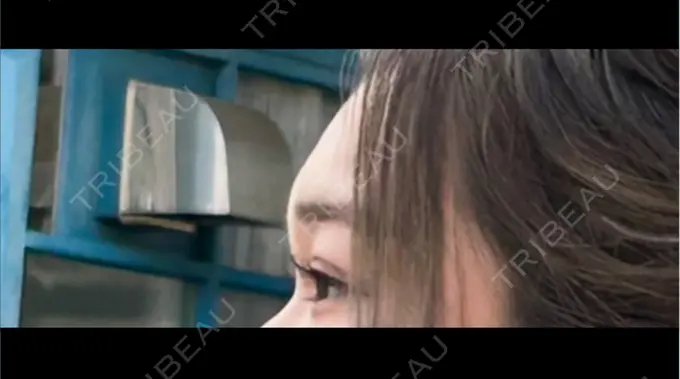 ヒアルロン酸注入（額） / ボトックス（眉間） / ボトックス（額） DMTC美容皮膚科 大宮院 BEFORE メイン用