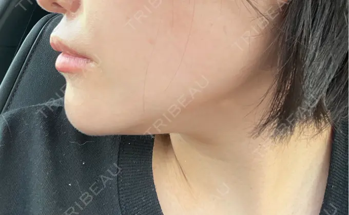 ボトックス（エラ・小顔） / ボトックス（首） DMTC CLINIC 渋谷院 BEFORE メイン用