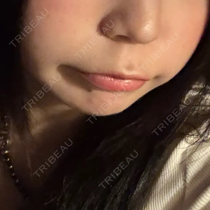 糸リフト / 脂肪吸引（顔） / ジョールファット除去 / 脂肪吸引注射（顔） / ヒアルロン酸注入（あご） / ボトックス（エラ・小顔） 新宿美容外科ネビュラクリニック BEFORE メイン用