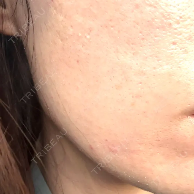 水光注射（ハリ・美肌） Chloe Cheongdam Clinic （クロエチョンダムクリニック） BEFORE メイン用