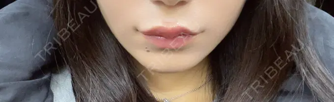 ヒアルロン酸注入（唇） 目白ホワイトクリニック BEFORE メイン用