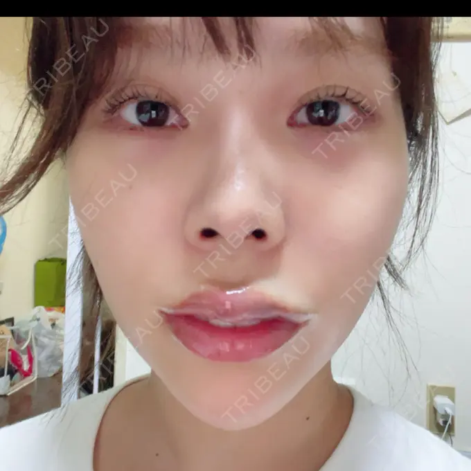 ボトックス（口角） / ヒアルロン酸注入（頬） おおたかの森ビューティークリニック BEFORE メイン用