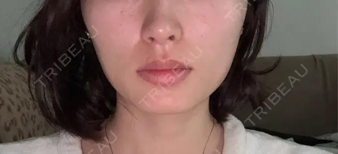 ボトックス（あご） / ボトックス（エラ・小顔） / ボトックス（眉間） 新宿TAクリニック BEFORE メイン用