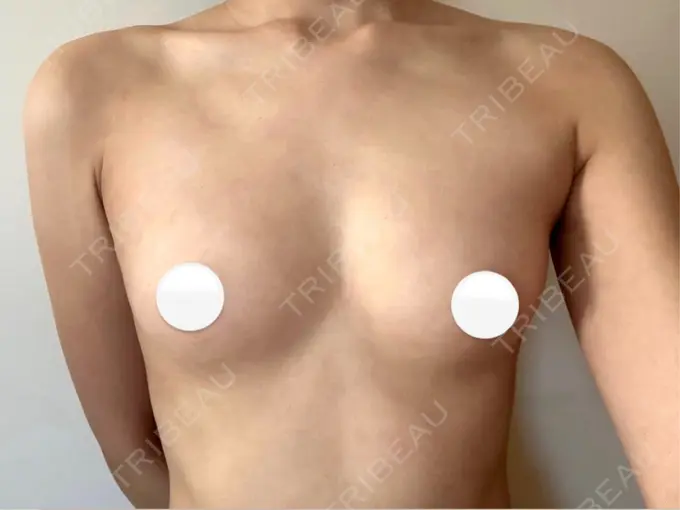 脂肪吸引（脚） / 豊胸（脂肪注入） 湘南美容クリニック Regno 銀座院 BEFORE メイン用