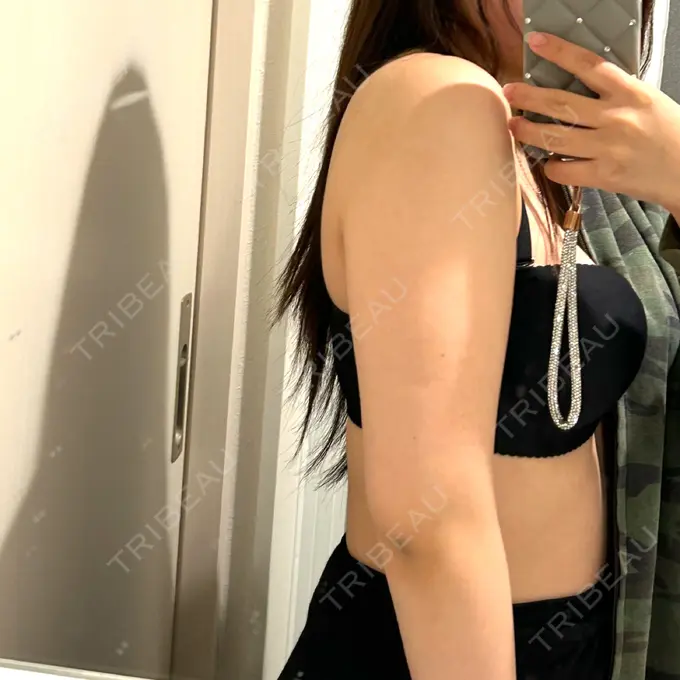 脂肪吸引（顔） / 脂肪吸引（二の腕） / ジョールファット除去 / 脂肪吸引（肩） 湘南美容クリニック Regno 銀座院 BEFORE メイン用