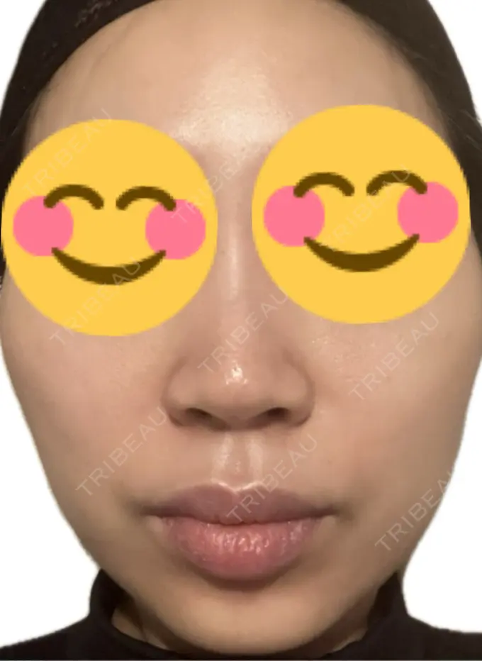 プラセンタ注射 美容皮膚科エルムクリニック 麻布院 BEFORE メイン用