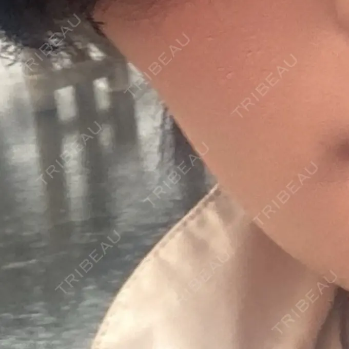 医療脱毛（顔） ZX-CLINIC BEFORE メイン用