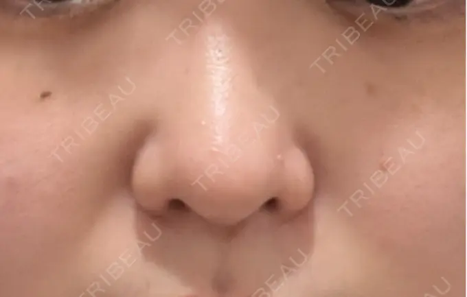 ヒアルロン酸注入（鼻翼基部） THE FIRST CLINIC 町田院 BEFORE メイン用