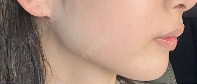 医療脱毛（顔） / レーザートーニング（美白・肝斑） ZX-CLINIC BEFORE メイン用