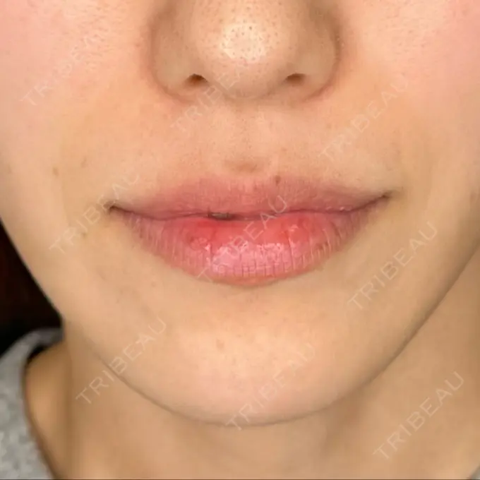 肌ヒアルロン酸注入（たるみ・シワ改善） / イオン導入 / ルメッカ ルラ美容クリニック 静岡院 BEFORE メイン用