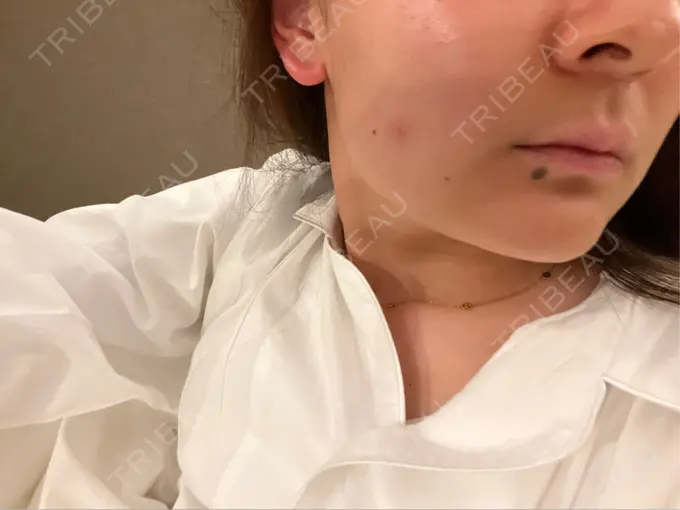 ハイフ（顔） GRACY TOKYO CLINIC【グレイシートウキョウクリニック】 BEFORE メイン用