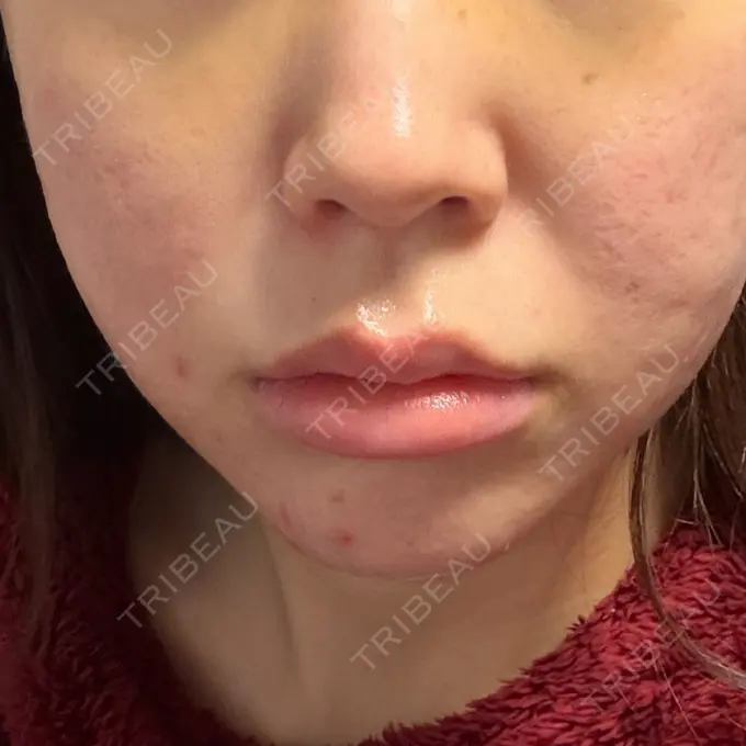 肌育注射（ジュベルックなど） Natural Skin Clinic 笹塚院 BEFORE メイン用