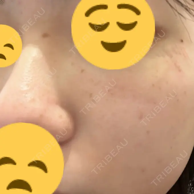 光治療（フォトフェイシャルなど） 東京美容外科 福山院 BEFORE メイン用