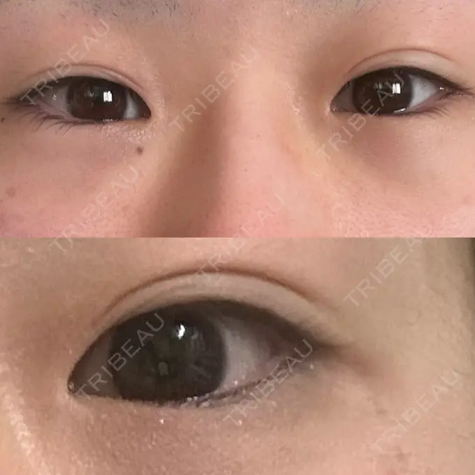 二重埋没 / 目頭切開 / クマ治療 / 目尻切開 / タレ目形成・グラマラスライン（切開） / 目尻靭帯移動 エターナル美容クリニック BEFORE メイン用
