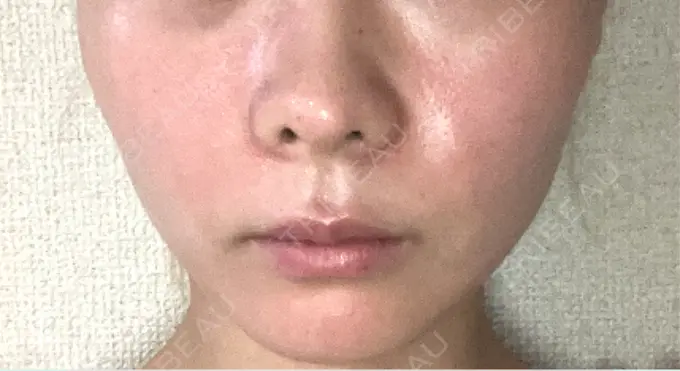 RF（高周波）たるみ治療 / インモード 豊洲内科・糖尿病 / 形成・美容外科クリニック BEFORE メイン用