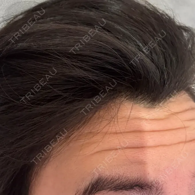 ボトックス（額） DMTC CLINIC 日本橋院 BEFORE メイン用