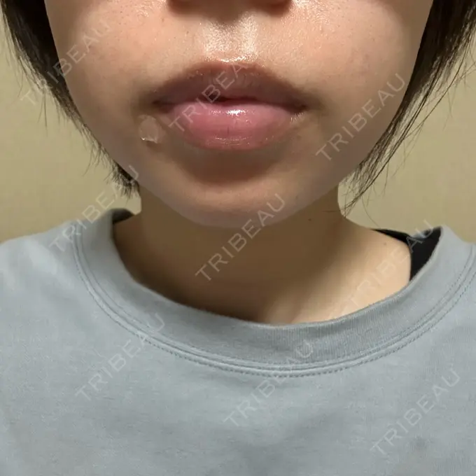 ヒアルロン酸注入（あご） Otus Clinic 【オータスクリニック】 BEFORE メイン用