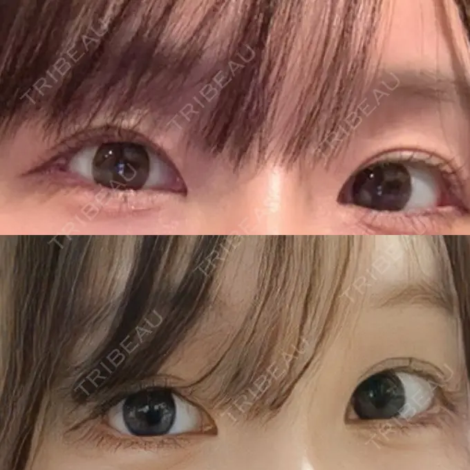 クマ治療 / 下まぶたの脂肪取り / 脂肪注入（目の下） / ボトックス（額） 藤・ナチュレ美容クリニック 銀座院 BEFORE メイン用