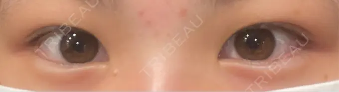 二重埋没 恵聖会クリニック 心斎橋院 BEFORE メイン用