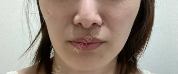 ヒアルロン酸注入（涙袋） / ヒアルロン酸注入（唇） 博多美容外科/美容皮膚科 ビラビューティークリニック BEFORE メイン用