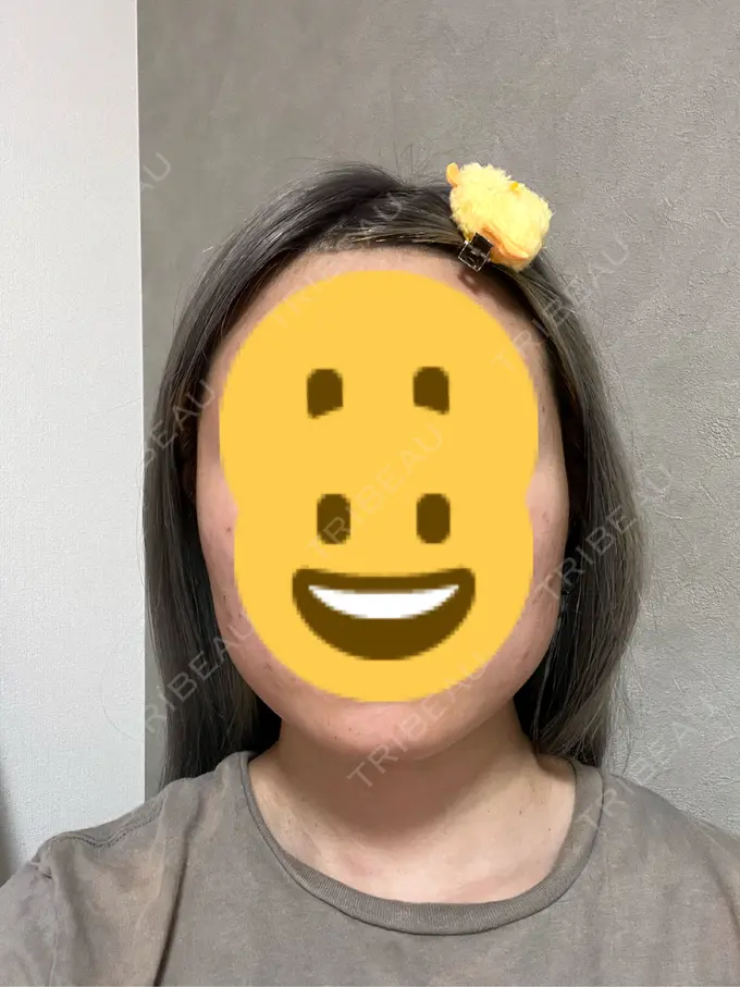 ボトックス（エラ・小顔） 共立美容外科 神戸三宮院 BEFORE メイン用