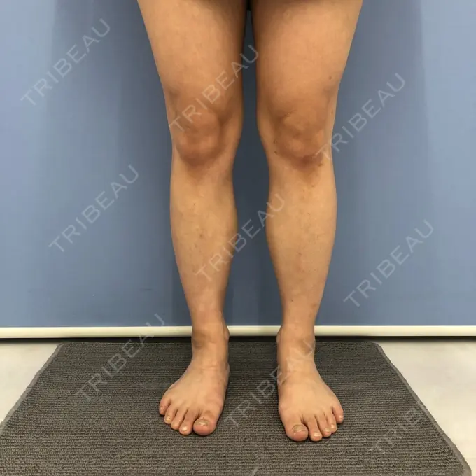 その他（ボディ） 湘南美容クリニック 仙台院 BEFORE メイン用