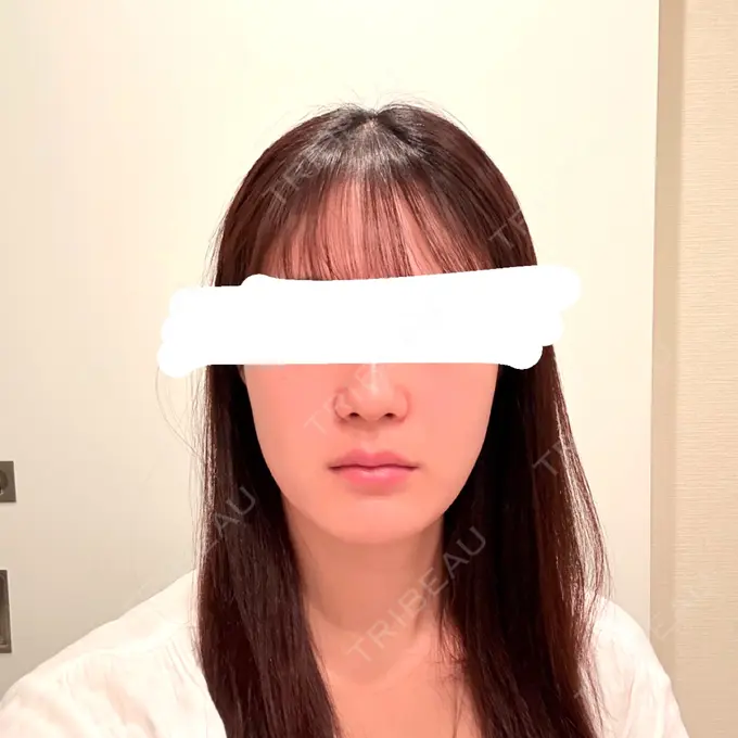 ボトックス（エラ・小顔） / その他（輪郭） 大美会クリニック 心斎橋本院 BEFORE メイン用