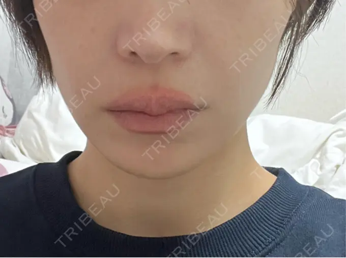 ボトックス（エラ・小顔） TCB東京中央美容外科 新宿東口院 BEFORE メイン用