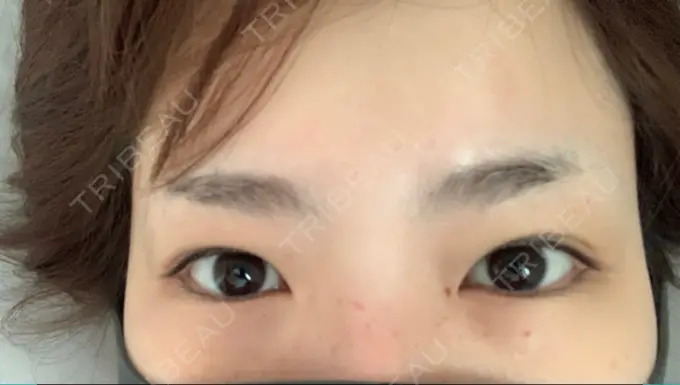 二重埋没 / 上まぶたの脂肪取り / 自然癒着法 FROM B整形外科 (旧バウム整形外科) BEFORE メイン用