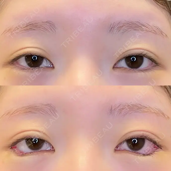 目尻切開 / タレ目形成・グラマラスライン（埋没） / ボトックス（タレ目） LOUIS CLINIC 二子玉川院【ルイクリニック】 BEFORE メイン用
