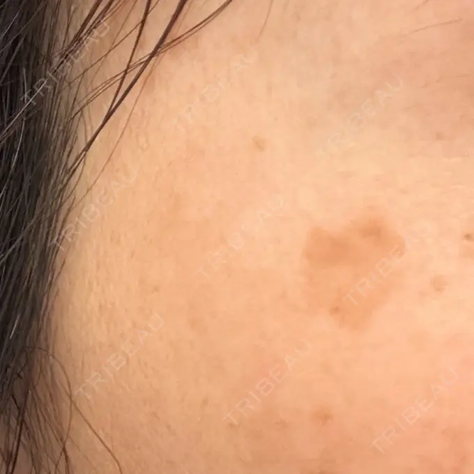 ルメッカ 東京美容外科 名古屋院 BEFORE メイン用