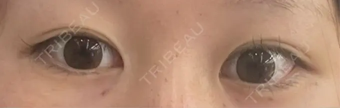 ヒアルロン酸注入（涙袋） / ボトックス（タレ目） アネシス美容クリニック BEFORE メイン用