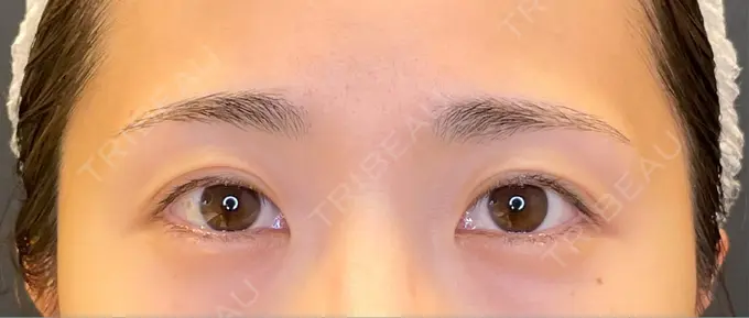 目尻切開 / タレ目形成・グラマラスライン（埋没） LOUIS CLINIC 二子玉川院【ルイクリニック】 BEFORE メイン用